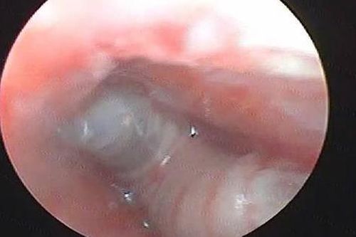 Thấy trẻ bị đau tai kèm chảy máu, gia đình đưa đi khám thì sốc nặng