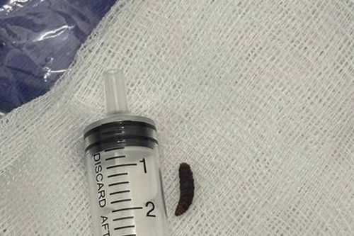 Bé 14 tháng tuổi quấy khóc dữ dội, bác sĩ phát hiện dòi sống trong tai