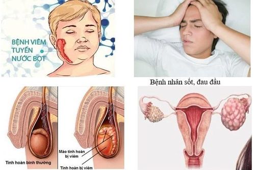 Nam bệnh nhân 41 tuổi bị biến chứng nặng do quai bị