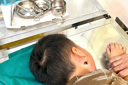 Điều trị thành công ca bệnh whitmore nguy hiểm ở trẻ 4 tuổi