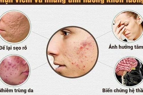 Dùng thuốc và cách chăm sóc da mụn viêm đỏ tại nhà