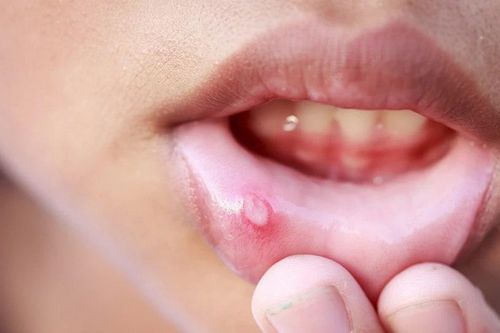 Nhiệt miệng thường xuyên: Nguyên nhân và yếu tố cảnh báo bệnh