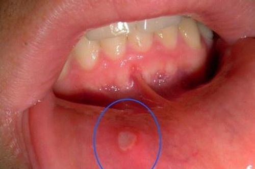 7 dấu hiệu bất thường ở miệng cảnh báo cơ thể thiếu magie