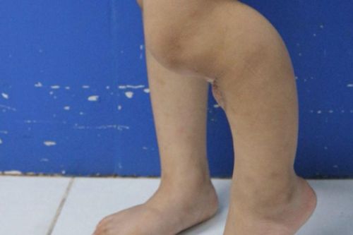 Khoét bột để đắp lá khi đã được bó bột, bố mẹ khiến con gái xương không thể liền