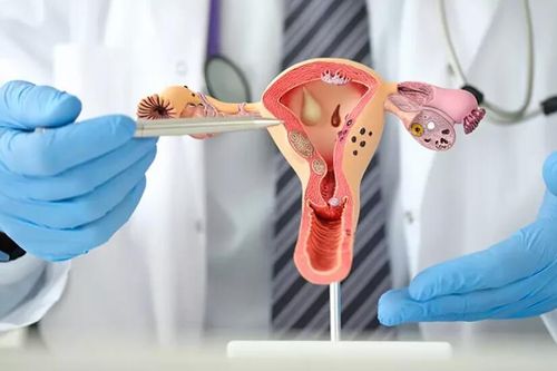 Nguyên nhân gây buồng trứng đa nang