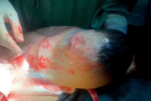 Bé trai chào đời còn nguyên bọc điều, bác sĩ cũng ngỡ ngàng
