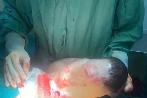 Khoảnh khắc hiếm gặp: Trẻ sơ sinh chào đời còn nguyên trong bọc ối