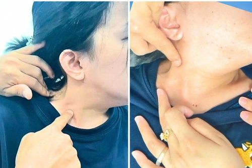 Cổ cô gái trẻ bất động vì căn bệnh hiếm gặp