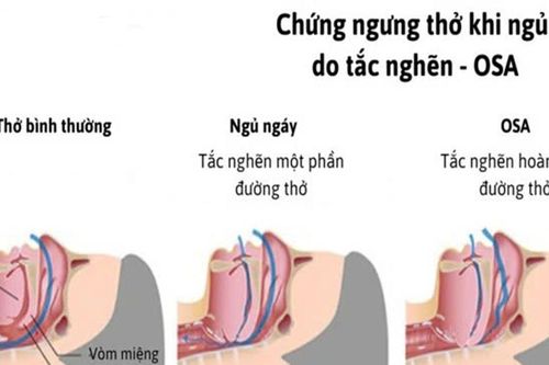 Ngáy to, buồn ngủ ban ngày: Dấu hiệu của hội chứng nguy hiểm OSA