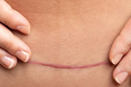 Để vết mổ sau sinh mau lành và không để lại sẹo