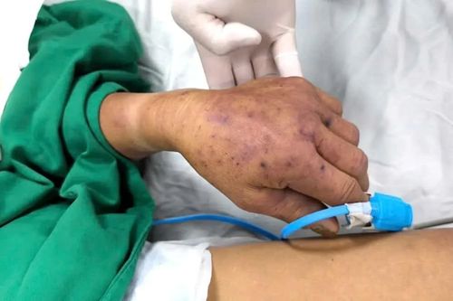 Biểu hiện bất thường sau bữa ăn cảnh báo bệnh nguy hiểm