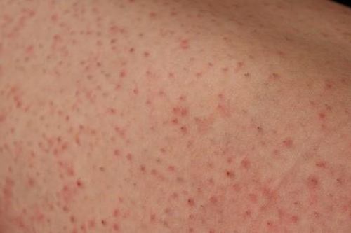 Điều trị viêm nang lông tại nhà bằng thuốc và các nguyên liệu tự nhiên