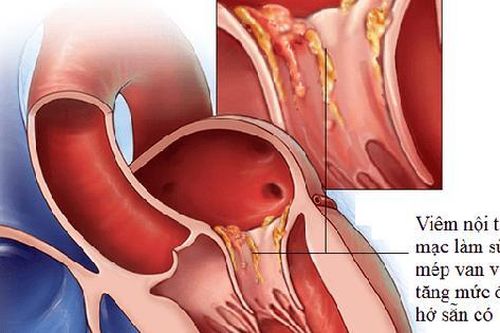 Triệu chứng viêm nội tâm mạc nhiễm trùng