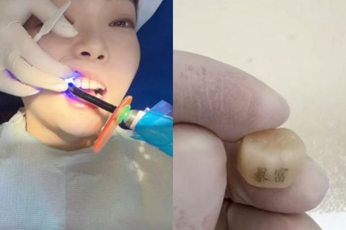 'Xăm răng' lên ngôi ở Trung Quốc: Giới trẻ khắc chữ 'Phát tài', 'Lên bờ' để cầu may