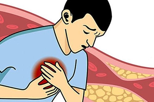 Nam bệnh nhân trẻ nhập viện vì bị nhồi máu cơ tim, nguyên nhân từ đâu?