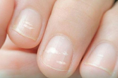 Dấu hiệu trên móng tay cảnh báo bệnh tật