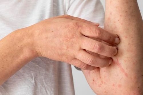 Các biện pháp phòng ngừa viêm da cơ địa