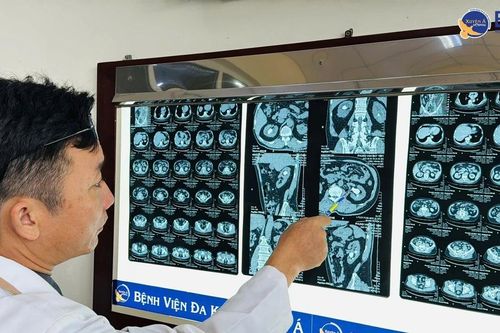 Lấy sỏi san hô kích thước lớn cho bệnh nhân 64 tuổi