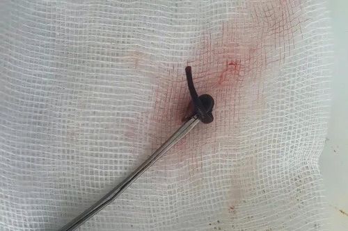 Phát hiện con vắt dài 3cm sống trong mũi cô gái hơn 1 tuần