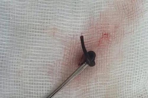 Ngạt mũi cả tuần, đi khám phát hiện vắt dài 3 cm trong hốc mũi