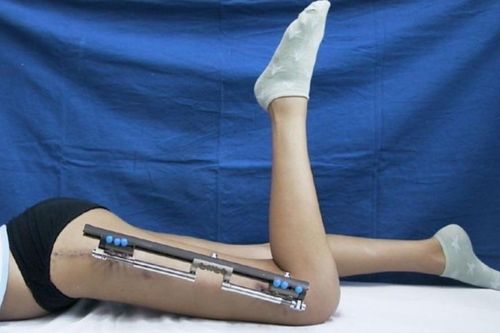 'Cưa chân' để được thấp đi