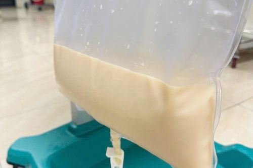 Lọc máu cứu người đàn ông có huyết tương đục như sữa