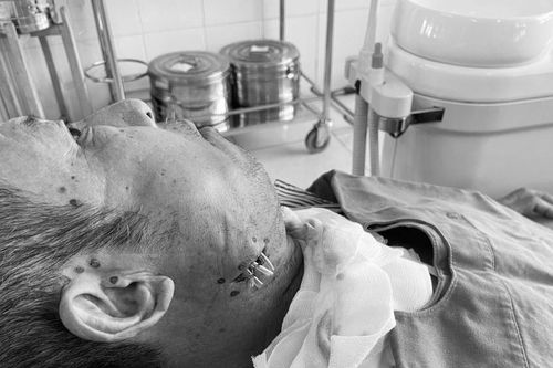 Tự ý đốt nhiệt chữa đau răng, nam bệnh nhân đối mặt nguy cơ tử vong