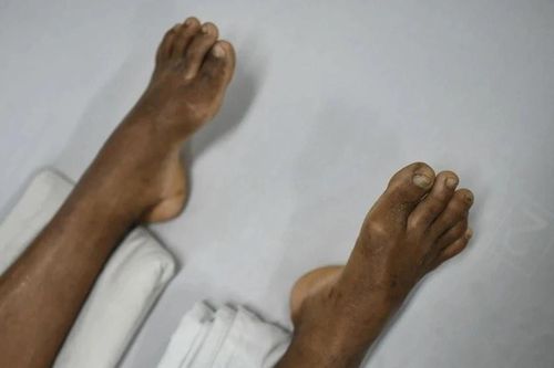 Thập tử nhất sinh chỉ vì chủ quan với chiếc răng sâu