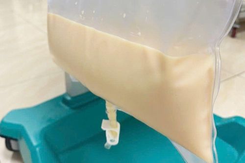 Người đàn ông 46 tuổi nhập viện trong tình trạng đau bụng, lọc mỡ máu trắng đục như sữa