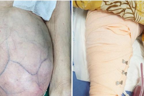 4 giờ phẫu thuật, bóc tách khối u 8,2kg khỏi đùi bệnh nhân