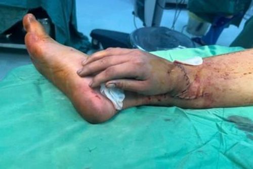 Phẫu thuật ghép bàn tay của sản phụ mang song thai bị tai nạn lao động vào cẳng chân