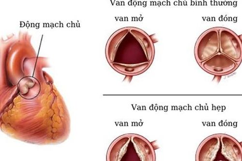 Biến chứng nguy hiểm hẹp van động mạch chủ và cách điều trị