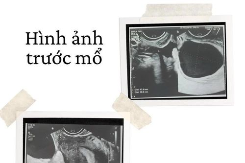 Cơn đau bụng bất thường không ngờ xoắn vòi tử cung hiếm gặp