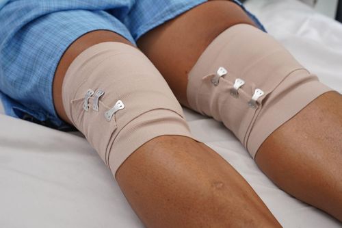 Ứng dụng keo PRF, bước tiến mới trong điều trị bệnh thoái hóa khớp gối