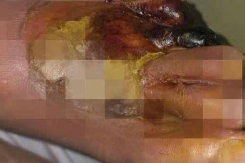 Một người đàn ông bị cháy đen bàn chân vì thói quen sưởi ấm bằng máy sấy tóc