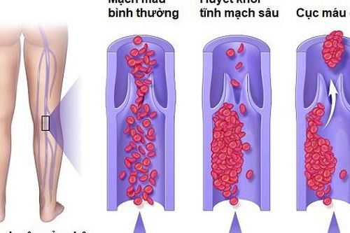 Các yếu tố nguy cơ gây bệnh huyết khối tĩnh mạch sâu