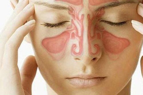 Viêm xoang mũi dị ứng do đâu, làm sao để tránh?