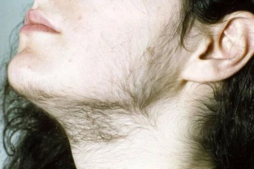 Cường androgen ở phụ nữ có biểu hiện gì?