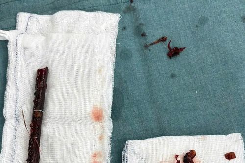 Ngã xuống ao, trẻ 3 tuổi bị cành cây đâm xuyên trực tràng, ruột non 4 tháng