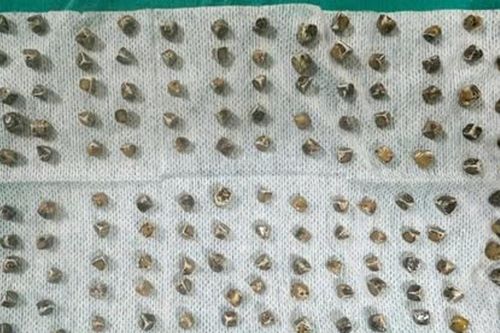 Đau bụng dữ dội, nữ bệnh nhân mang trong mình 130 viên sỏi