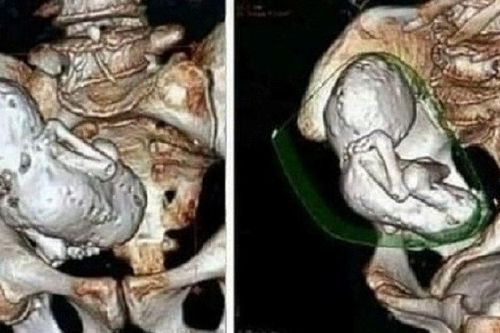 Đi khám vì đau bụng, cụ bà 73 tuổi bàng hoàng khi bác sĩ phát hiện thai nhi hóa đá suốt 30 năm