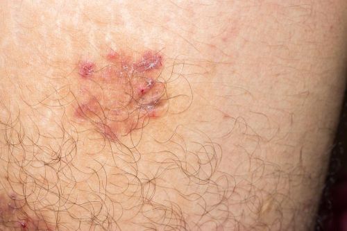 Vết phồng rộp trên da cảnh báo bệnh nguy hiểm, dễ chẩn đoán nhầm