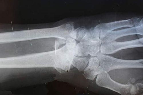 Nối liền xương gãy chỉ trong 5 phút nhờ 'keo siêu dính' Bone-02: Cuộc cách mạng y học khiến bác sĩ cũng không tin vào mắt mình!