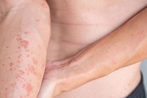 Cảnh giác với viêm da tiếp xúc dị ứng