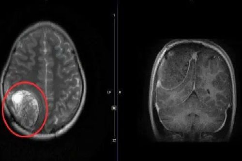 Bóc tách thành công khối u màng não tái phát cho bệnh nhi 15 tuổi