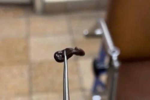 Chảy máu cam kéo dài, bé trai nhập viện vì vắt trú ngụ trong mũi
