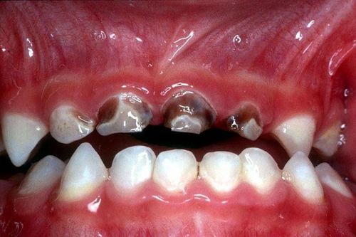 Hội chứng sâu răng do bú bình