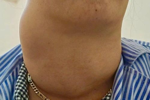 Nữ bệnh nhân mắc bướu giáp khổng lồ gây chèn ép vùng cổ