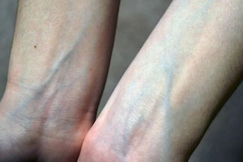 Vì sao máu luôn đỏ nhưng tĩnh mạch lại xanh?