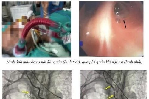 Hiếm gặp, ho ra máu ồ ạt từ nhánh lớn của động mạch vú